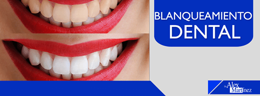 dr alex martinex blanqueamiento dental