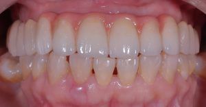 Implantes Dentales en El Salvador