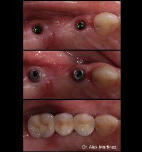 Prótesis dental sobre implantes
