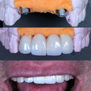 Prótesis fija sobre implantes dentales