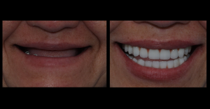 Rehabilitación Oral Completa con Implantes dentales