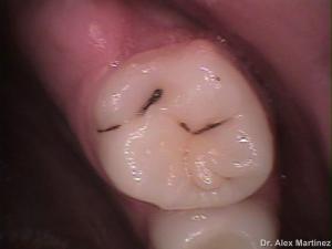 restauracin adhesiva directa en molar superior 20090517 1067101599
