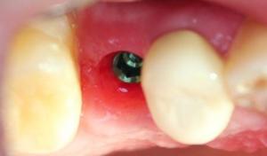  Implante Dental en Premolar Superior