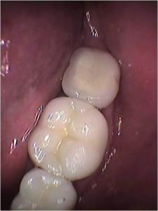 Implante Dental en Molar Inferior