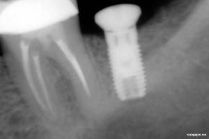 radiografa de implante ya colocado 20140827 1141851876