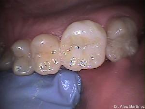 incrustacin de porcelana en molar superior 20090517 1352189158