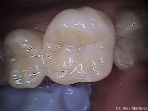 incrustacin de porcelana en molar superior 20090517 1601557564