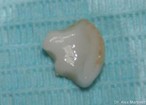 incrustacin de porcelana en molar superior 20090517 1716741789