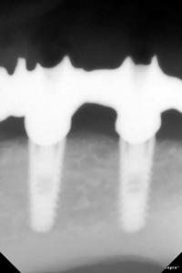2 implantes colocados en lado derecho de mandbula 20140829 1786075163