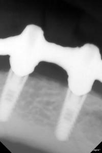 2 implantes colocados en lado izquierdo de mandbula 20140829 1128766384