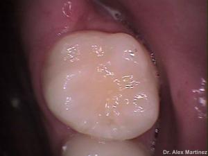 Restauración Adhesiva directa en molar superior