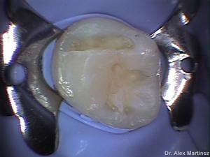 restauracin adhesiva directa en molar superior 20090517 1141219135