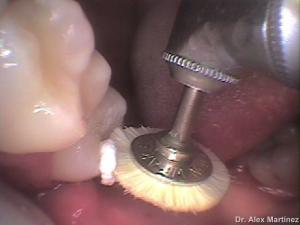 restauracin adhesiva directa en molar superior 20090517 1184076041