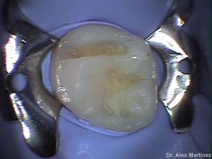 restauracin adhesiva directa en molar superior 20090517 1193198592