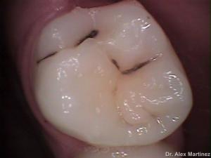 restauracin adhesiva directa en molar superior 20090517 1244272417