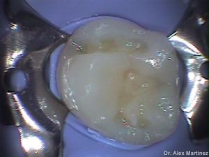 restauracin adhesiva directa en molar superior 20090517 1300683750