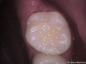 restauracin adhesiva directa en molar superior 20090517 1427609777
