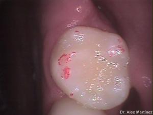 restauracin adhesiva directa en molar superior 20090517 1703227026