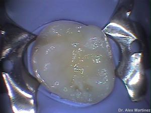restauracin adhesiva directa en molar superior 20090517 1817887365